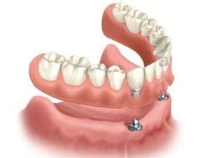 Illustration depicting how lower implant overdentures connect to the top of two dental implants.