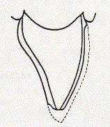 Diagram depicting how porcelain veneers cover the front aspect and incisal edge of an anterior tooth.
