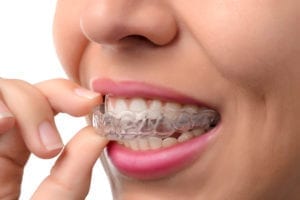 Woman placing a clear aligner tray that's similar to Invisalign.