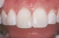 An image of a chipped tooth after dental bonding.