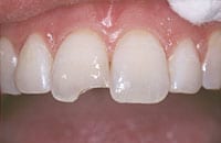 An image of a chipped tooth in need of dental bonding repair.