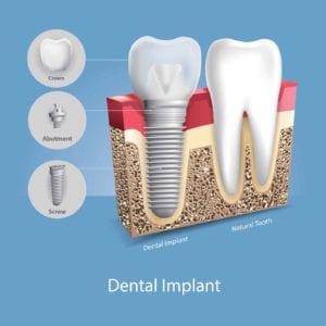 illustration of a dental implant next to a tooth