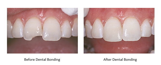 Before and After Dental Bonding repairing a chipped tooth