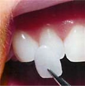 A porcelain veneer being placed on a tooth. 