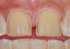 tooth prep for porcelain veneers