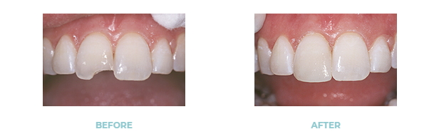 before and after a dental bonding repair