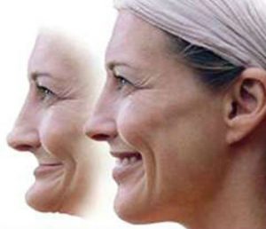 An image of a woman before and after facial collapse.