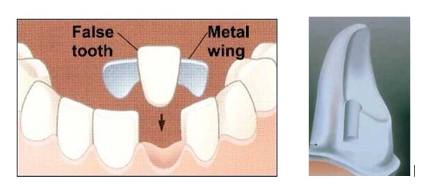 Two illustrations. One of a Maryland bridge being placed and another of the notch that has to be placed into teeth to hold it in place. 