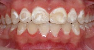 Example of decalcification on teeth after braces.